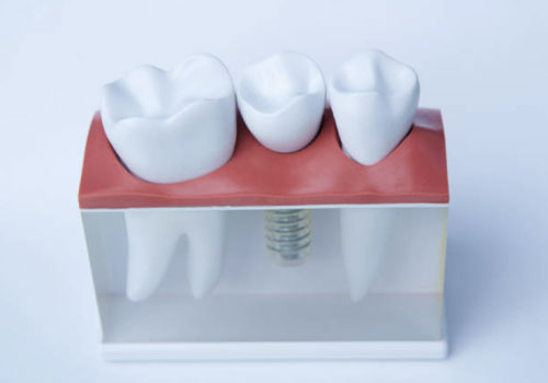 ¿Qué son los implantes dentales corticales? 2 IMPLANTES DENTALES CORTICALES