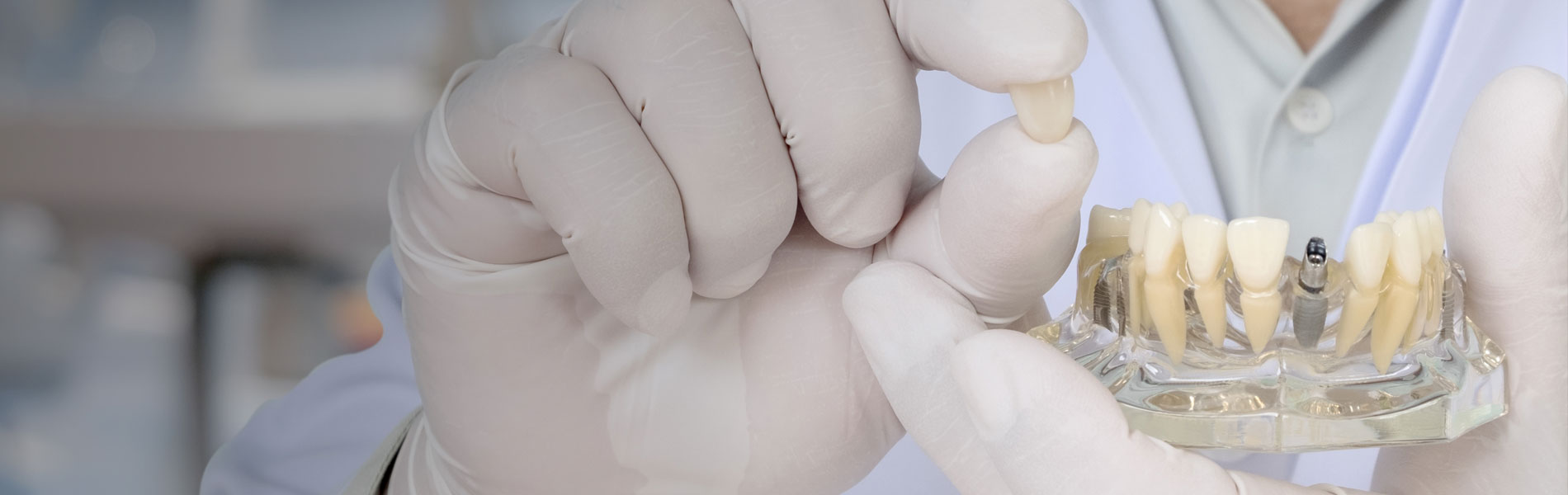 En este momento estás viendo ¿Qué son los implantes dentales corticales?