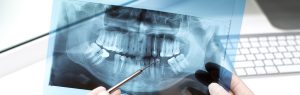 Lee más sobre el artículo ¿Qué son las radiografías extraorales y para qué se utilizan en odontología?