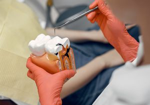 Lee más sobre el artículo Obturación dental: Definición y tipos