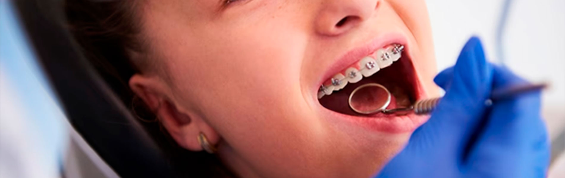 En este momento estás viendo ¿Por qué se mueven los dientes después de una ortodoncia?